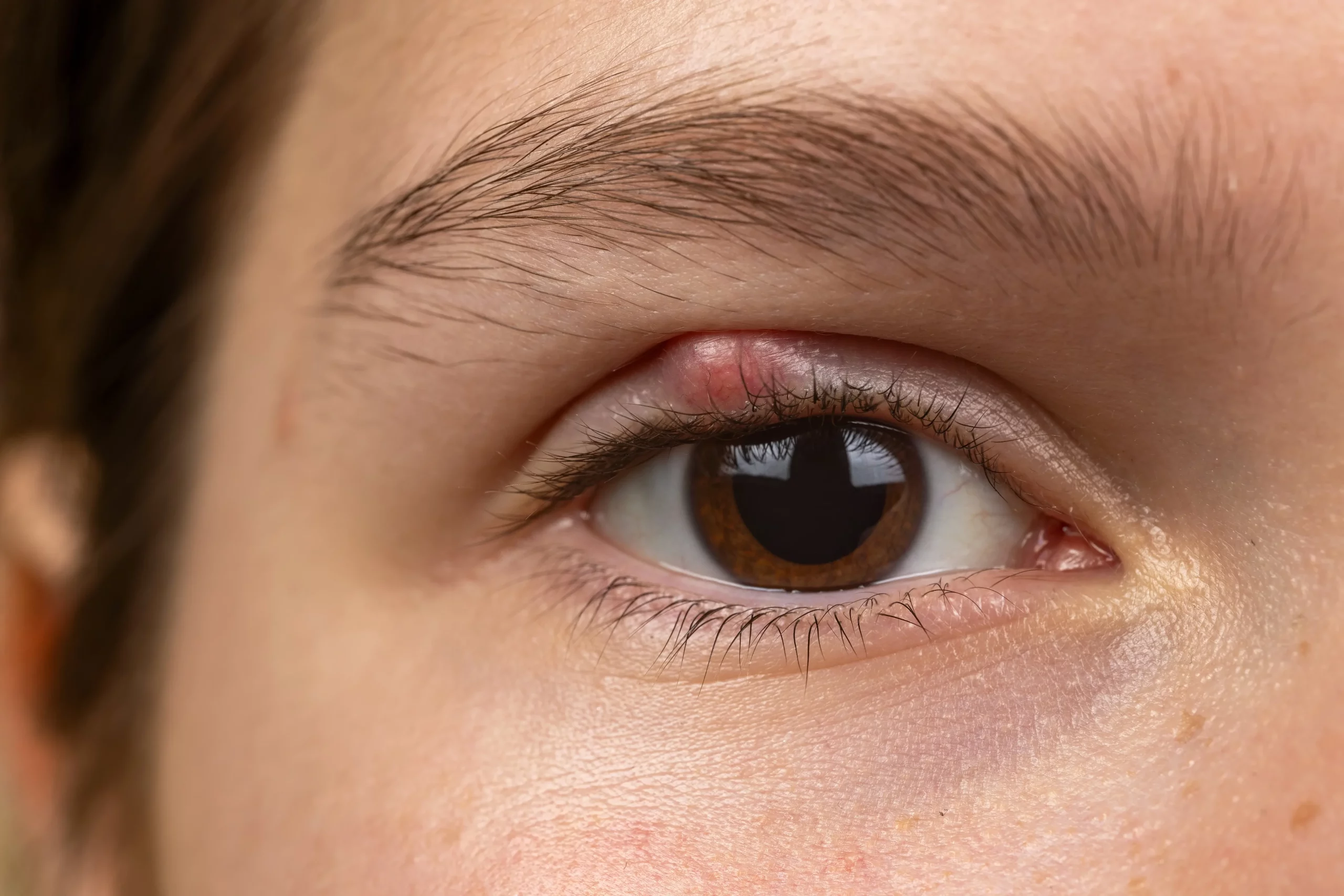 Chalazion — illustration