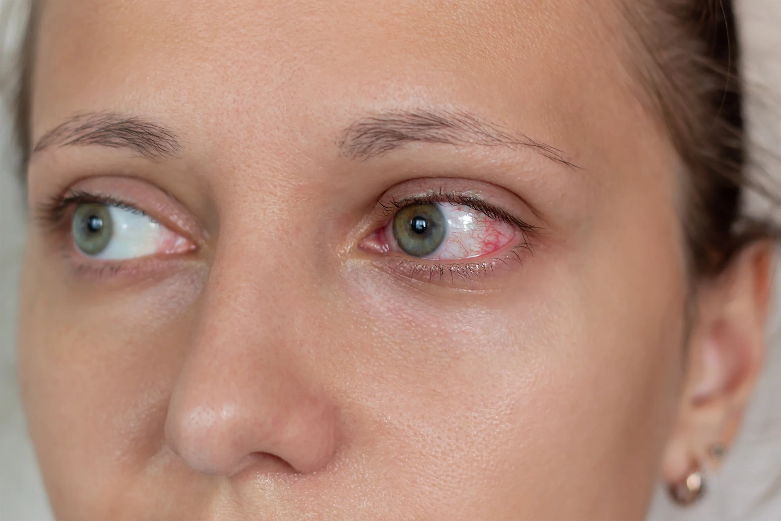 Quels sont les symptômes de la sécheresse oculaire ? — illustration