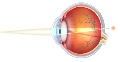 Presbytie — illustration