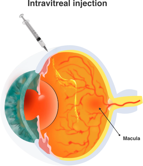 Injection intra-vitréenne (IVT) — illustration