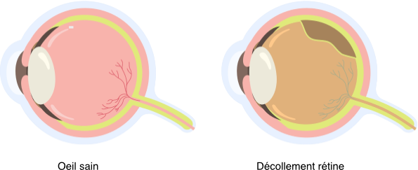 Les pathologies rétiniennes — illustration