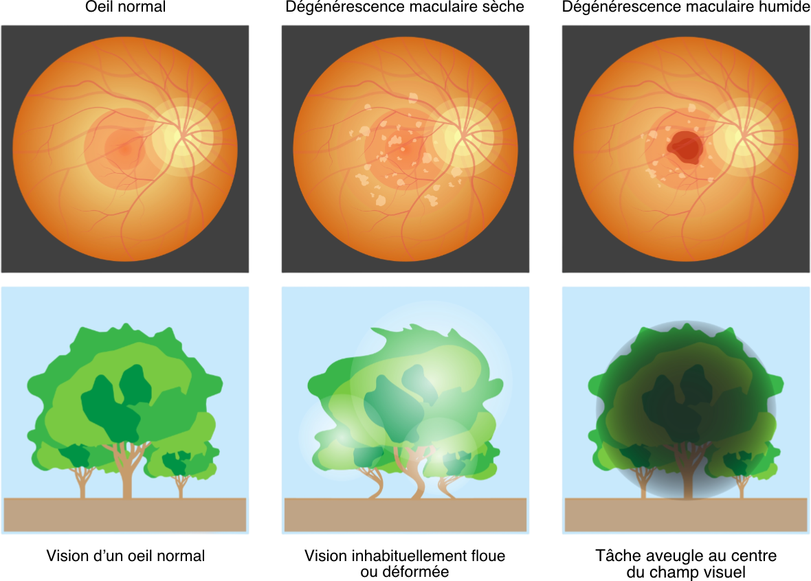 Les symptômes & diagnostic — illustration