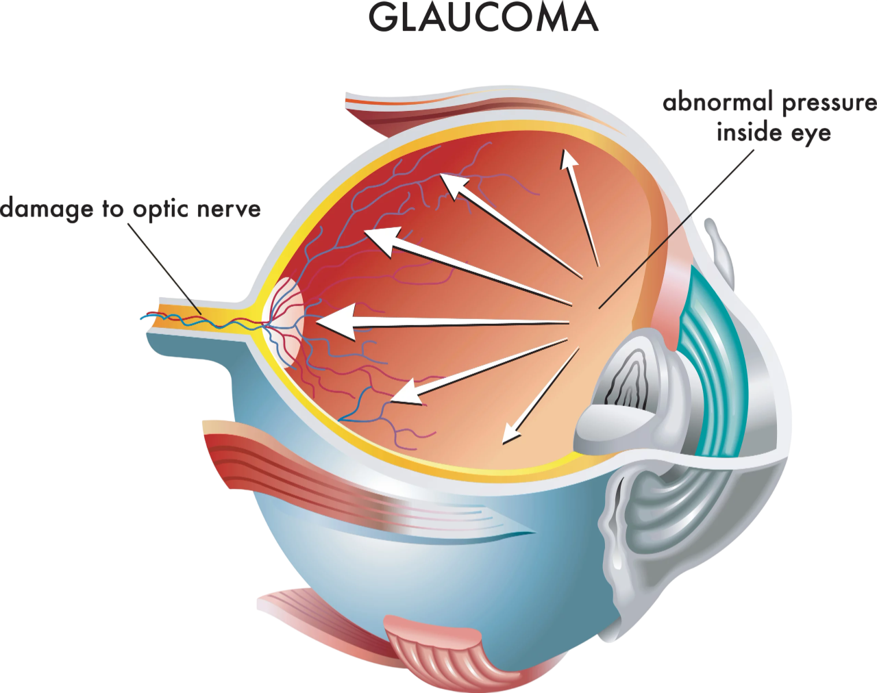 Le glaucome — illustration