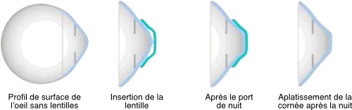 Orthokératologie — illustration