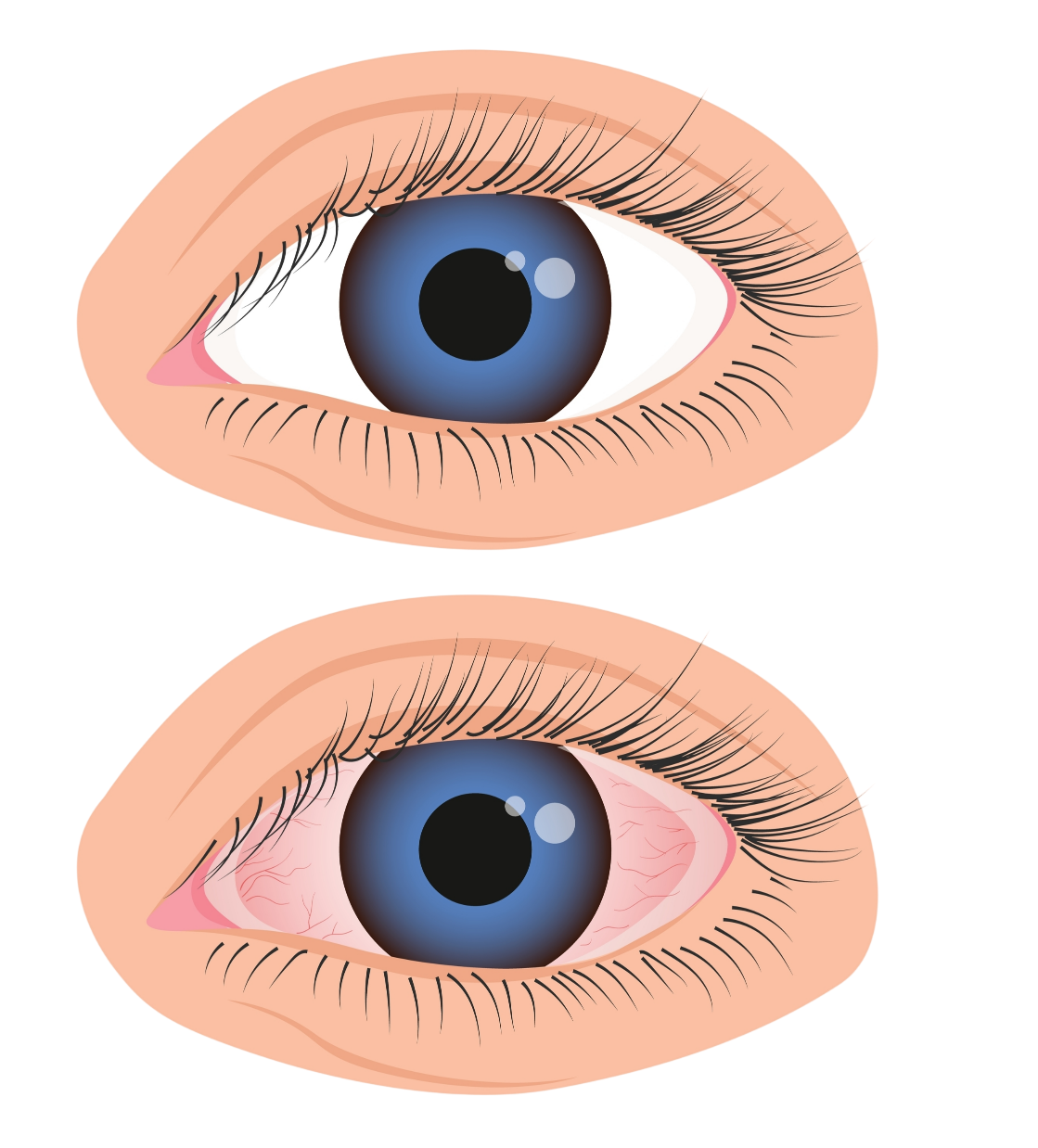 Quelles sont les causes de l’uvéite ? — illustration