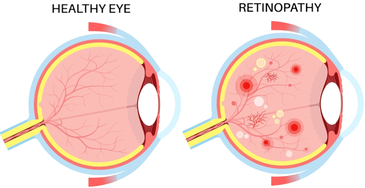 Les principales maladies de la rétine — illustration